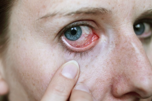 Dor nos olhos