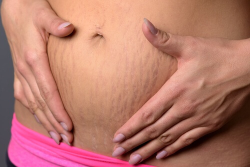 Estrias na barriga
