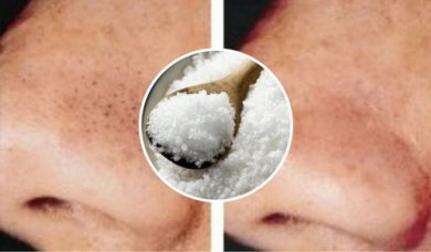 Como utilizar o sal contra cravos e espinhas