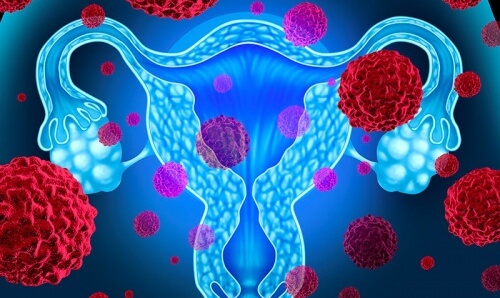 Câncer de endométrio: 5 aspectos que precisam ser considerados