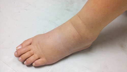 Inchaço nos pés é um sintoma de insuficiência renal