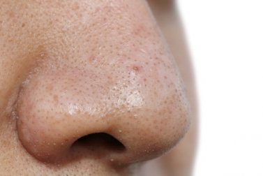 5 máscaras faciais para remover as espinhas