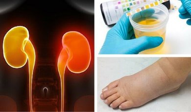 8 sintomas de insuficiência renal que muitos ignoram