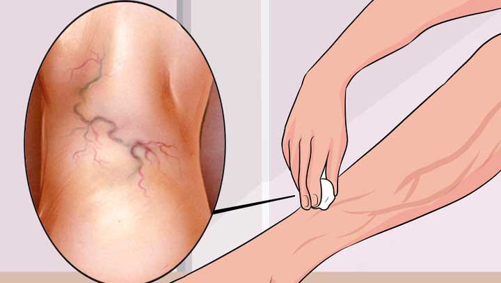 tratamento_natural_para_varizes