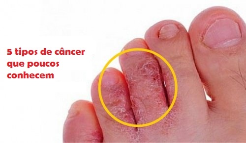 5 tipos de câncer que poucos conhecem
