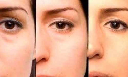 Dicas para se livrar das bolsas nos olhos