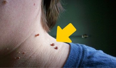 6 conselhos para eliminar naturalmente os acrocórdons