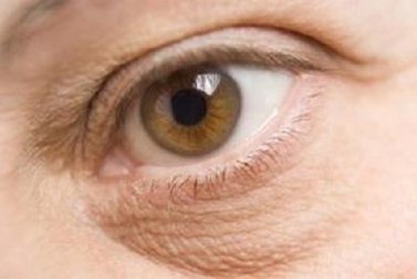 Os 5 melhores remédios caseiros para atenuar as bolsas nos olhos