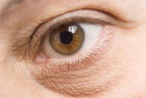 efeitos-estresse-bolsas-sob-os-olhos