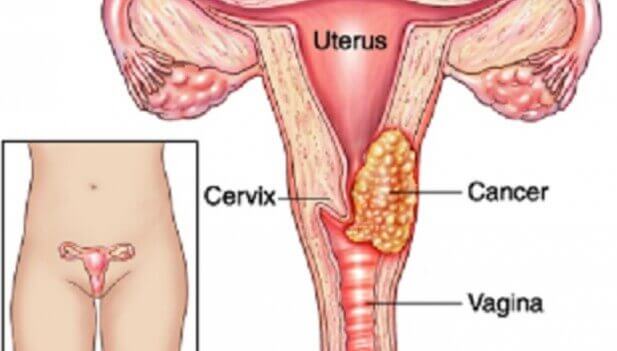 7 fatores que podem influenciar o surgimento do câncer do colo do útero