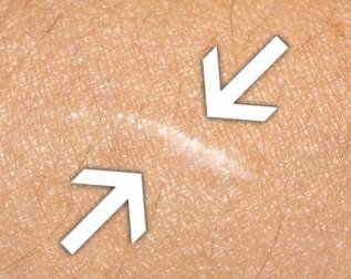 Os melhores remédios naturais para cicatrizar feridas