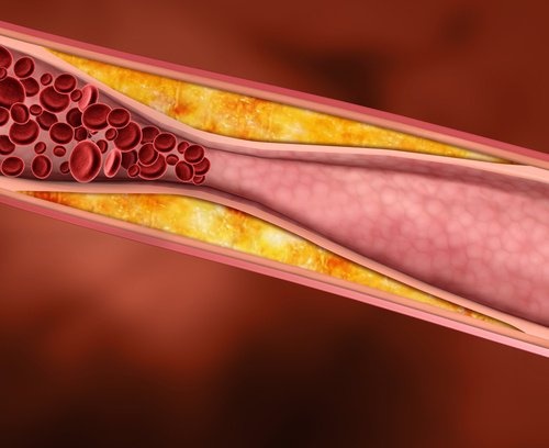 colesterol-ruim