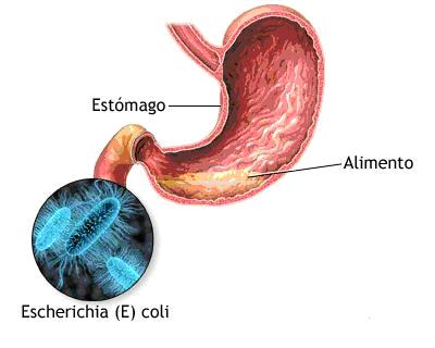 Ilustração sobre infecção estomacal