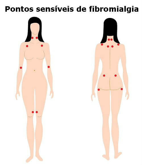 fibromialgia_pontos_sensíveis