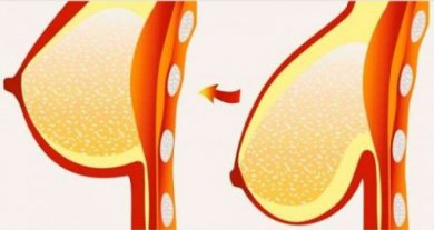 8 conselhos e remédios para evitar a flacidez e a queda dos seios