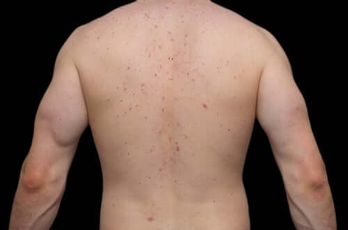 Causas da acne corporal