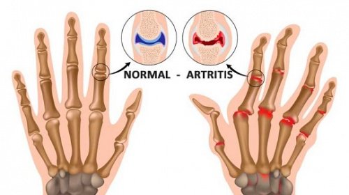 5 coisas que você provavelmente não sabia sobre a artrite 5 coisas que você provavelmente não sabia sobre a artrite
