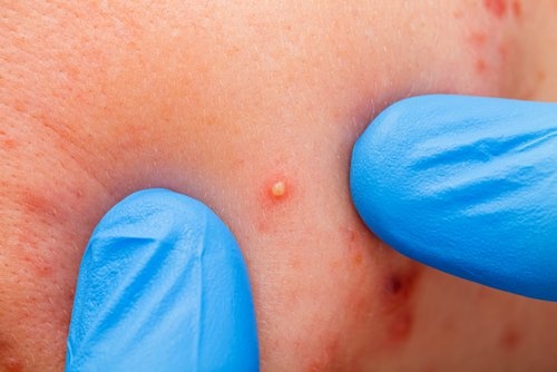 Acne é uma doença de pele comum
