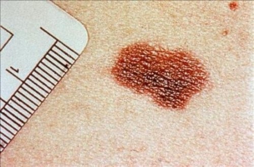 Doenças de pele mais comuns: câncer