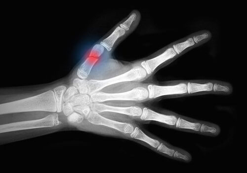Osteoporose nos ossos da mão