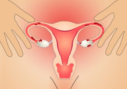 Desenho da endometriose no útero
