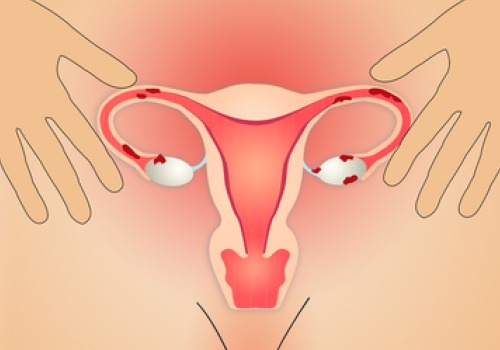 Causas e remédios para a endometriose