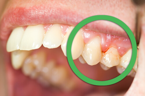 infecção periodontal pode causa dor nos dentes