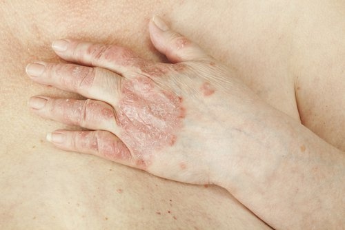 Psoriase na mão