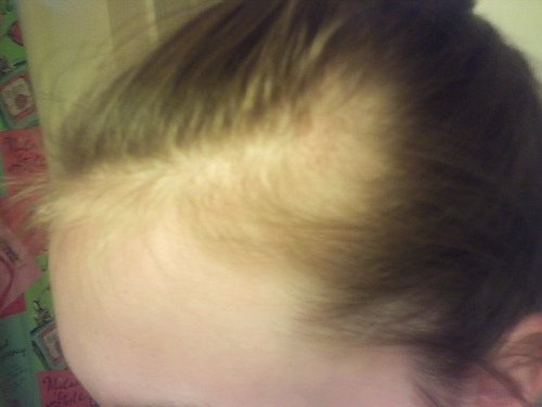 Alopecia areata na pele da cabeça
