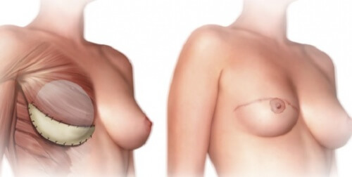 O que você deve saber antes da mastectomia?