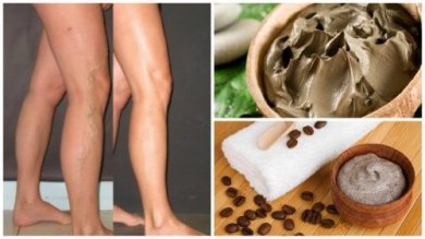 5 soluções naturais eficazes para combater as varizes