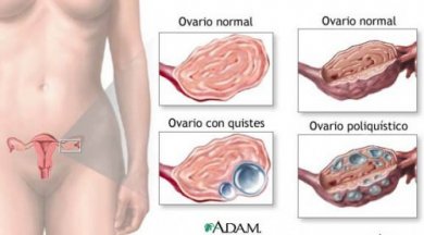 Cistos ovarianos: 9 fatos que toda mulher deve saber