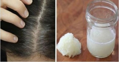 Queda de cabelo: tratamento com cebola e mel
