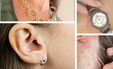 Como tratar a alergia às bijuterias?