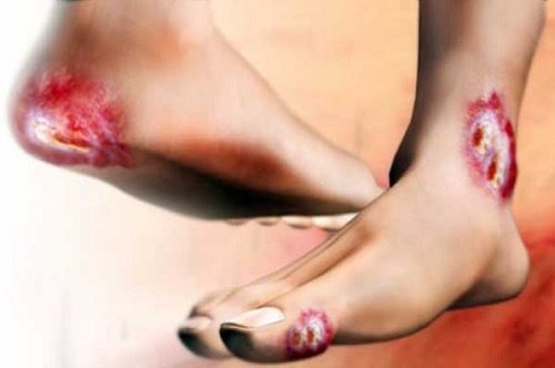 Efeito da diabetes nos pés