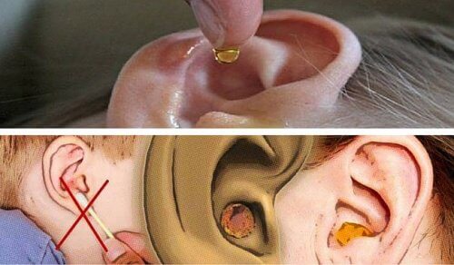 Como eliminar o excesso de cera dos ouvidos de forma natural