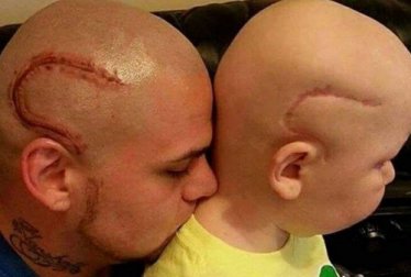 "Agora somos iguais". Pai tatua a cicatriz de seu filho que foi operado de um câncer