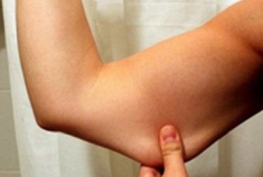 Método caseiro para tratar a flacidez dos braços