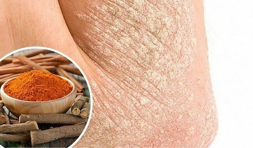 Psoríase: 7 dicas para tratá-la de maneira natural