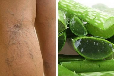 Complemento natural com babosa para tratar as úlceras varicosas