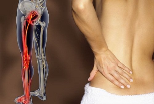 Como aliviar as dores no nervo ciático com exercícios