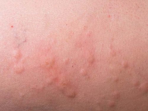 Alergias e erupções na pele por causa do estresse