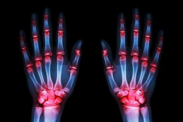 Segundo um estudo, em 5 ou 10 anos haverá tratamento para "frear" a artrose