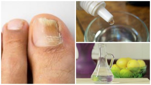 Fabrique um remédio “antifungos” para as unhas