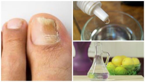 Fabrique o seu próprio remédio “antifungos” para as unhas Fabrique o seu próprio remédio “antifungos” para as unhas