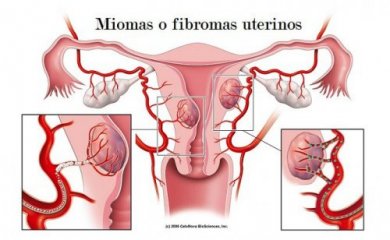 Miomas uterinos: 5 coisas que deveríamos saber