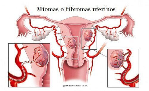 Miomas uterinos: 5 coisas que deveríamos saber