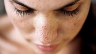 Estas 6 soluções naturais ajudarão a remover manchas e cravos