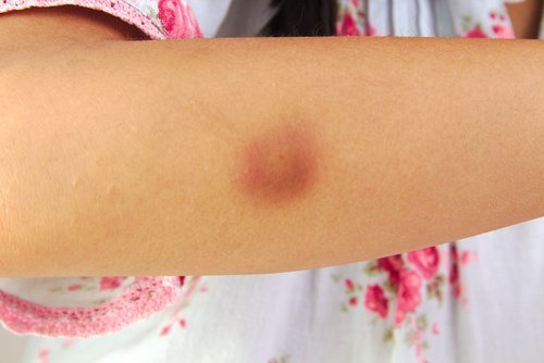 vick-vaporub-contra-hematomas