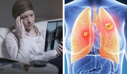 O câncer de pulmão é muito mais mortal nas mulheres